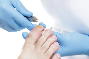 Wrastający paznokieć